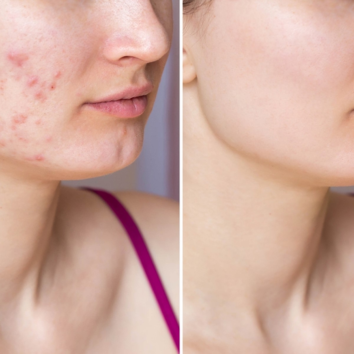 Acne scar removal