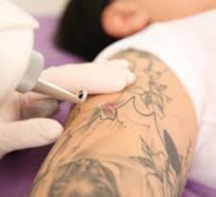 laser tattoo removal