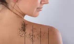 laser tattoo removal laser tattoo removal