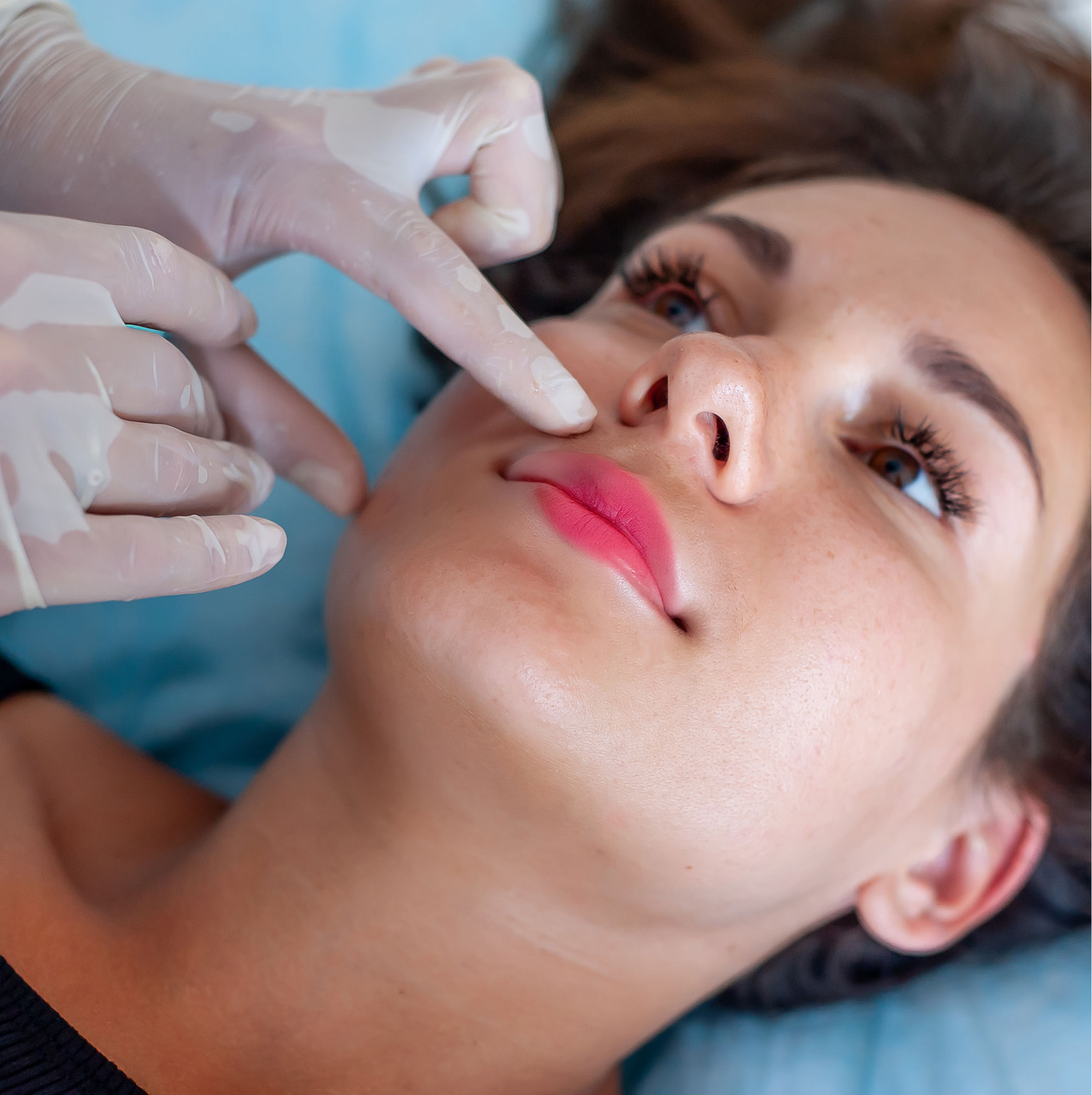 Juvederm Lip Filler