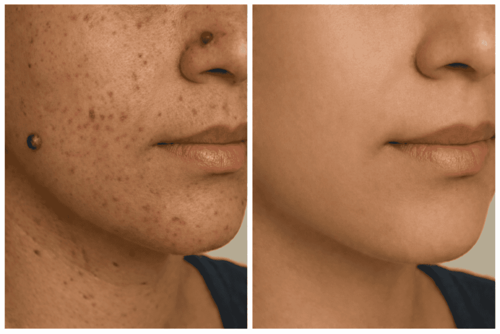 how to remobve skin tag