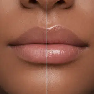 lip-filler-treatment-in-chennai lip-filler-treatment-in-chennai