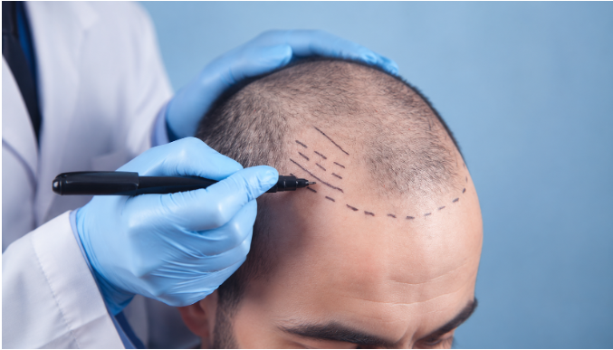 process in hair transplant